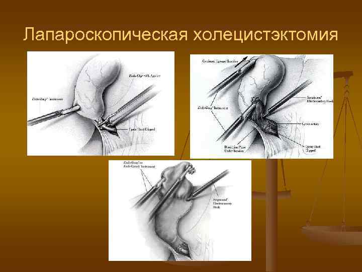 Перенесенная холецистэктомия. Холецистэктомия лапароскопически.