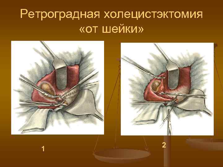Ретроградная холецистэктомия  «от шейки»      2  1 