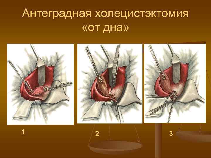 Антеградная холецистэктомия  «от дна» 1   2  3 
