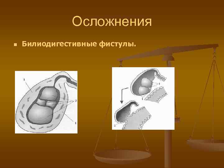    Осложнения n  Билиодигестивные фистулы. 