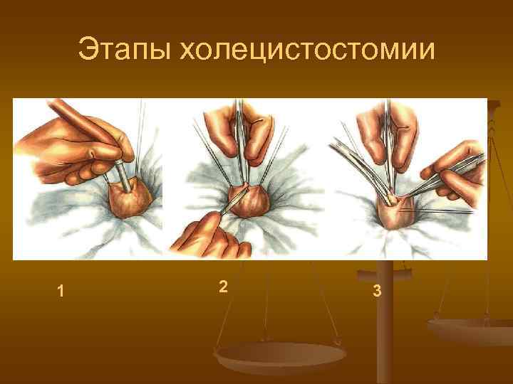   Этапы холецистостомии 1  2  3 