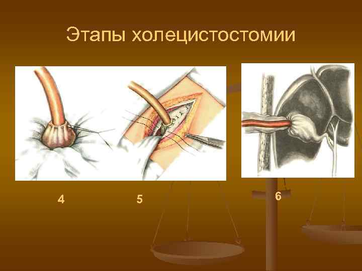  Этапы холецистостомии 4   5  6 