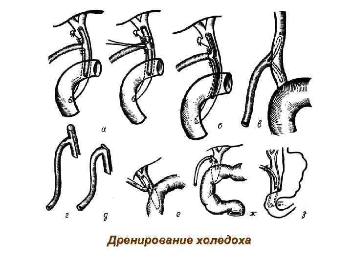 Дренирование холедоха 
