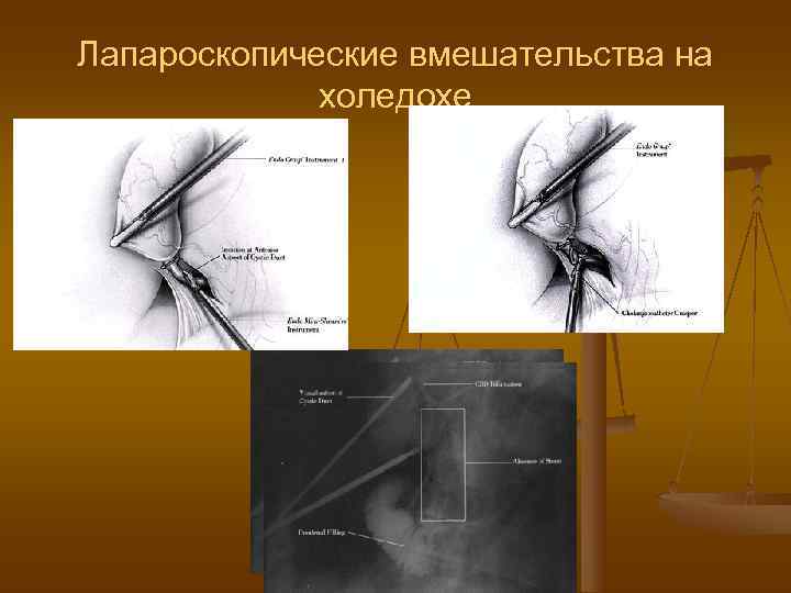 Лапароскопические вмешательства на   холедохе 