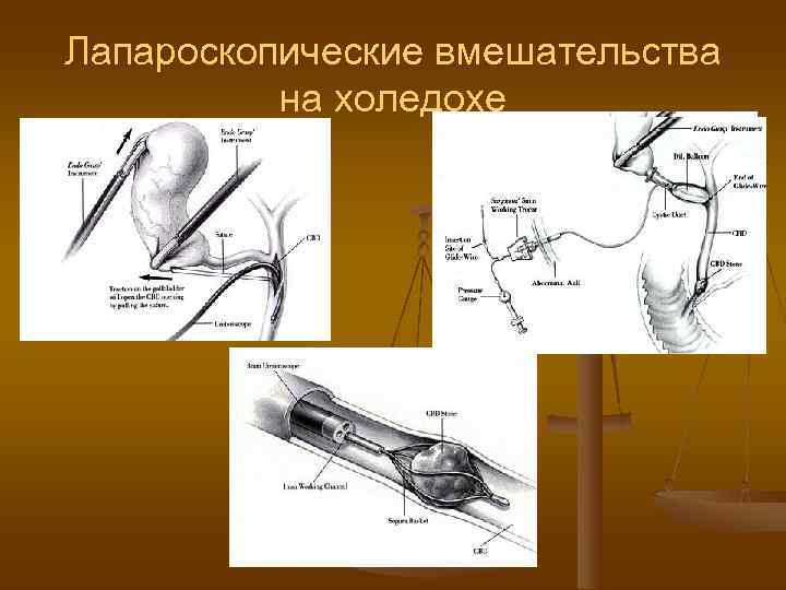 Лапароскопические вмешательства  на холедохе 