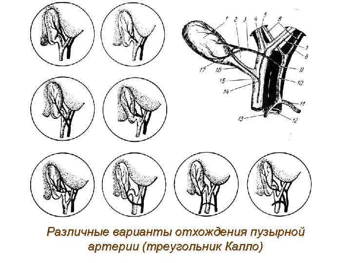 Различные варианты отхождения пузырной  артерии (треугольник Калло) 