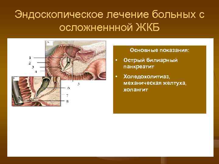 Эндоскопическое лечение больных с  осложненнной ЖКБ    Основные показания:  