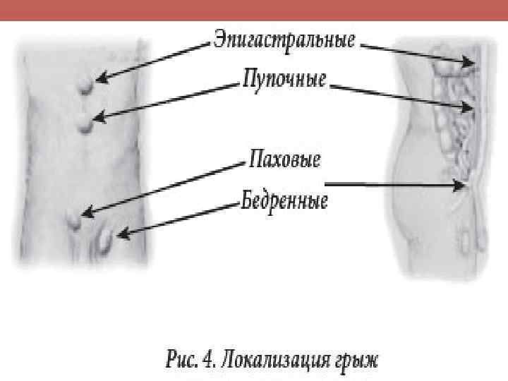 Бедренная грыжа у детей фото