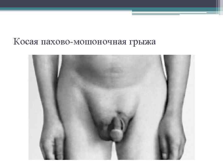 Косая пахово-мошоночная грыжа 