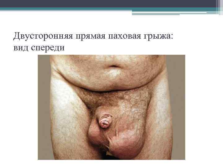 Двусторонняя прямая паховая грыжа: вид спереди 