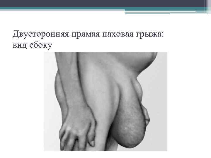 Двусторонняя прямая паховая грыжа: вид сбоку 
