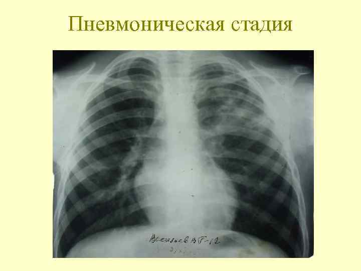Пневмоническая стадия 