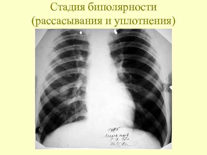   Стадия биполярности (рассасывания и уплотнения) 