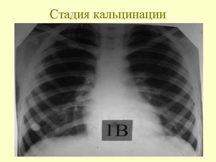 Стадия кальцинации 