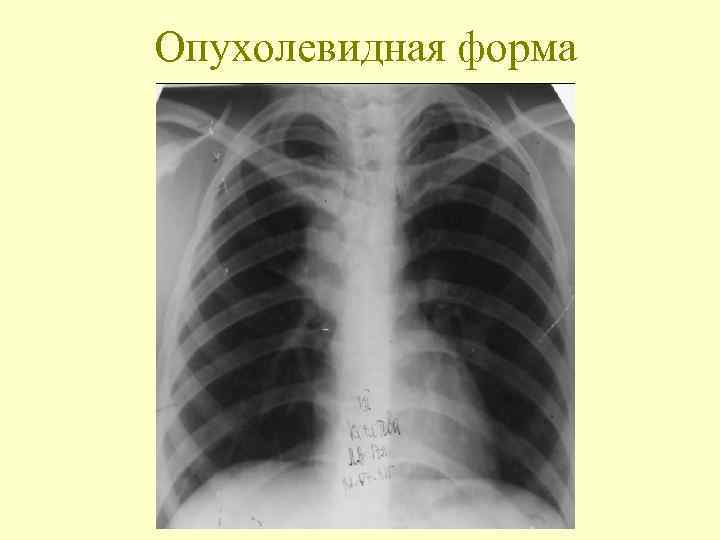 Опухолевидная форма 