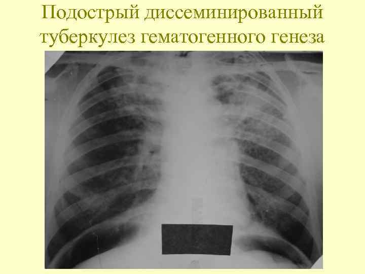 Подострый диссеминированный туберкулез гематогенного генеза 