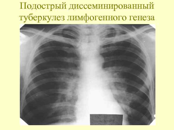 Подострый диссеминированный туберкулез лимфогенного генеза 