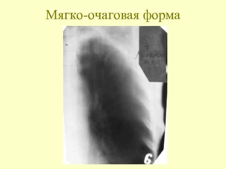 Мягко-очаговая форма 