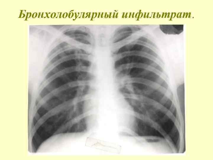 Бронхолобулярный инфильтрат. 