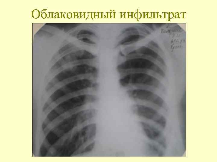 Облаковидный инфильтрат 