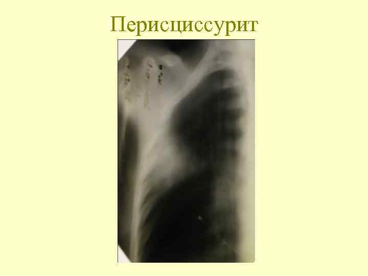 Перисциссурит 