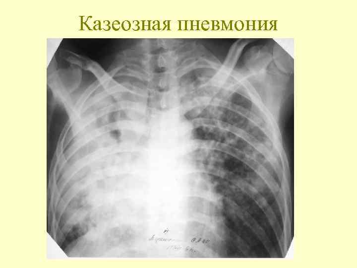 Казеозная пневмония 