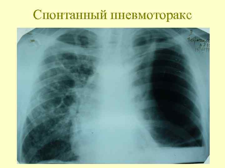 Спонтанный пневмоторакс 