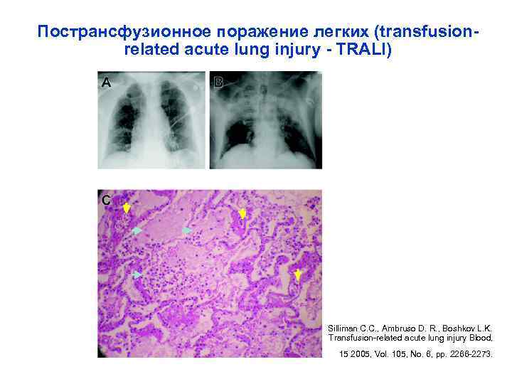 Пострансфузионное поражение легких (transfusion-   related acute lung injury - TRALI)  