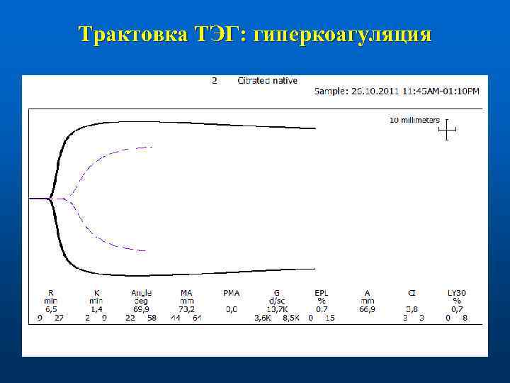 Трактовка ТЭГ: гиперкоагуляция 