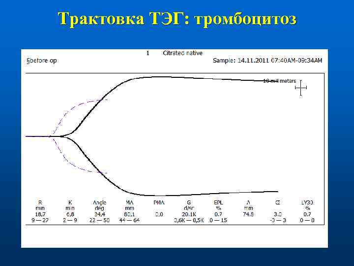 Трактовка ТЭГ: тромбоцитоз 