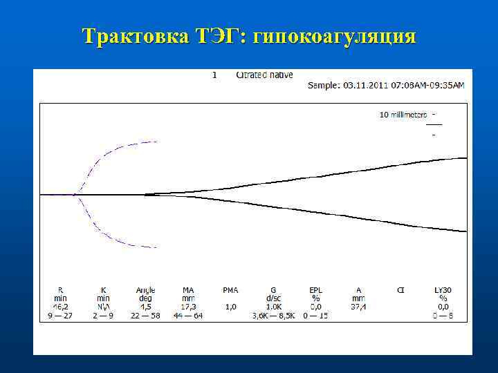 Трактовка ТЭГ: гипокоагуляция 