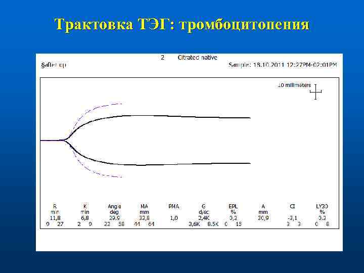 Трактовка ТЭГ: тромбоцитопения 