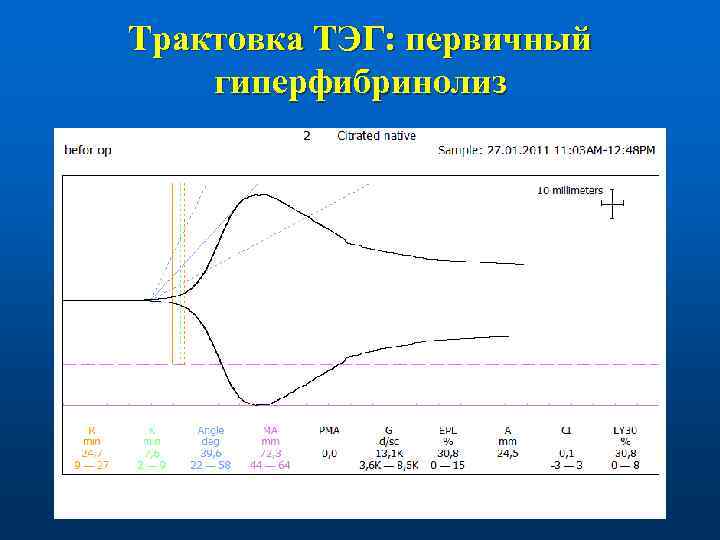 Трактовка ТЭГ: первичный гиперфибринолиз 