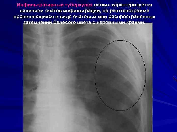  Инфильтративный туберкулез легких характеризуется  наличием очагов инфильтрации, на рентгенограмме проявляющихся в виде