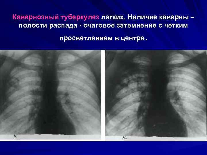 Кавернозный туберкулез легких. Наличие каверны –  полости распада - очаговое затемнение с четким