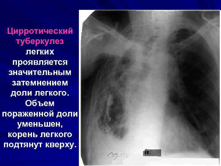  Цирротический туберкулез  легких  проявляется  значительным  затемнением  доли легкого.