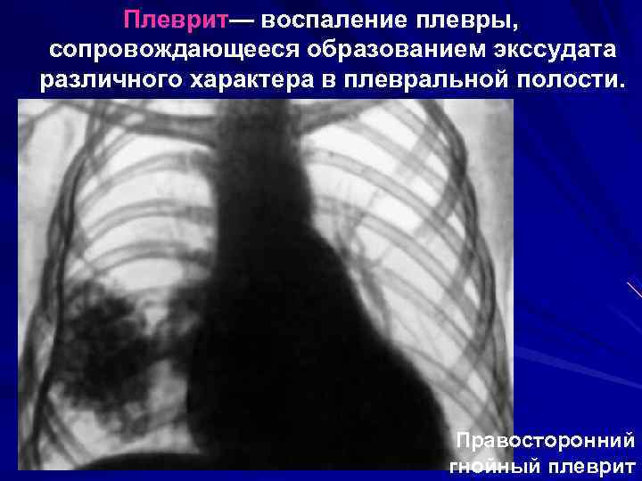  Плеврит— воспаление плевры,  сопровождающееся образованием экссудата различного характера в плевральной полости. 