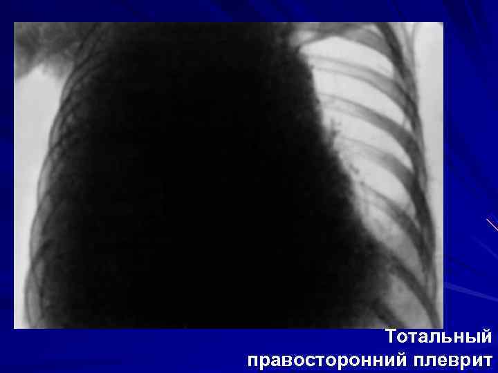   Тотальный правосторонний плеврит 