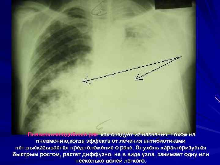  Пневмониеподобный рак как следует из названия, похож на   пневмонию, когда эффекта