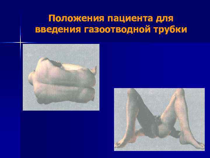  Положения пациента для введения газоотводной трубки 