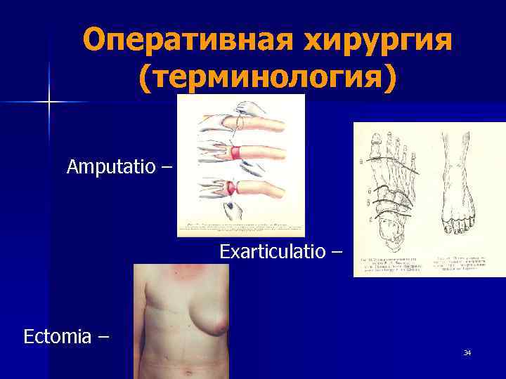  Оперативная хирургия   (терминология) Amputatio –     Exarticulatio –