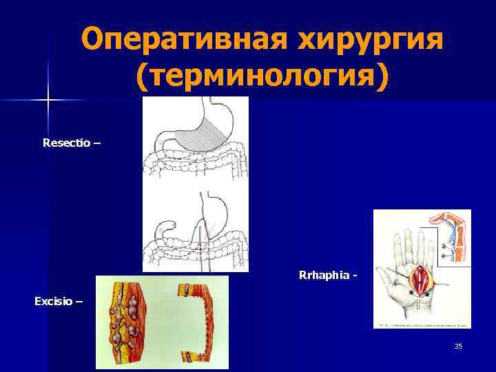   Оперативная хирургия  (терминология)  Resectio –    Rrhaphia -