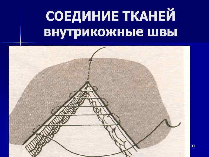СОЕДИНИЕ ТКАНЕЙ внутрикожные швы    43 