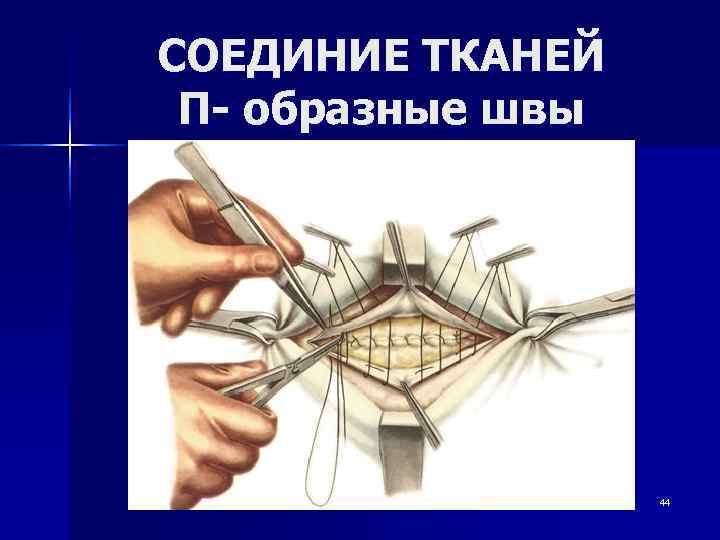 СОЕДИНИЕ ТКАНЕЙ П- образные швы    44 