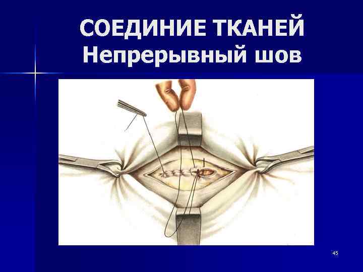 СОЕДИНИЕ ТКАНЕЙ Непрерывный шов    45 