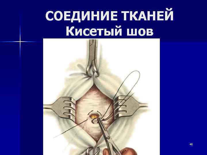 СОЕДИНИЕ ТКАНЕЙ  Кисетый шов    46 