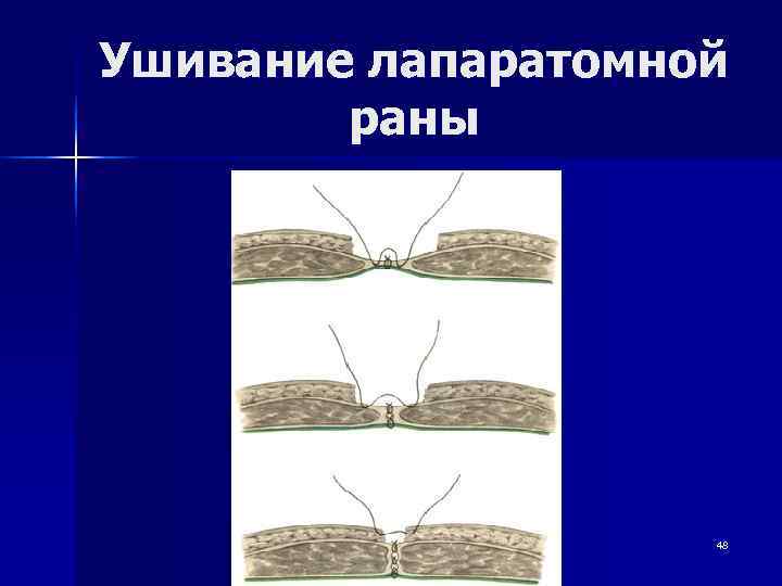 Ушивание лапаратомной   раны     48 