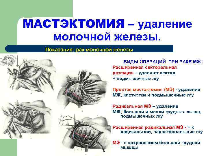 МАСТЭКТОМИЯ – удаление  молочной железы.  Показание: рак молочной железы   