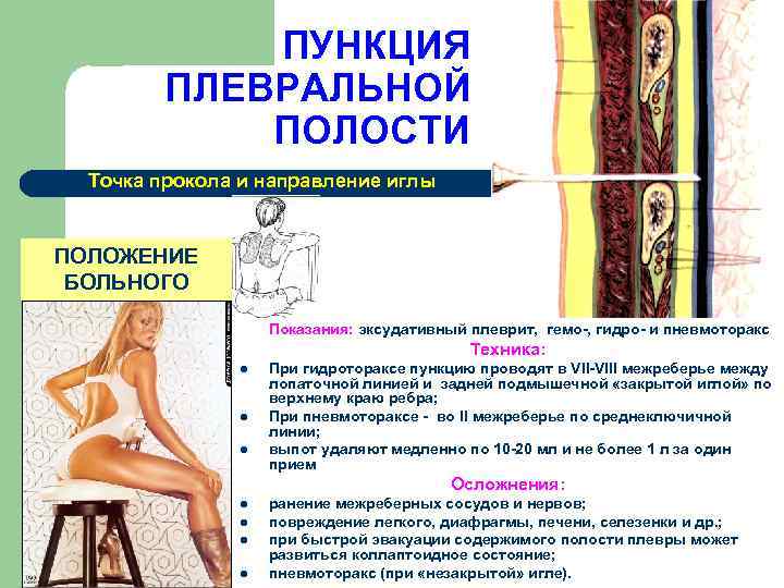    ПУНКЦИЯ   ПЛЕВРАЛЬНОЙ   ПОЛОСТИ  Точка прокола и