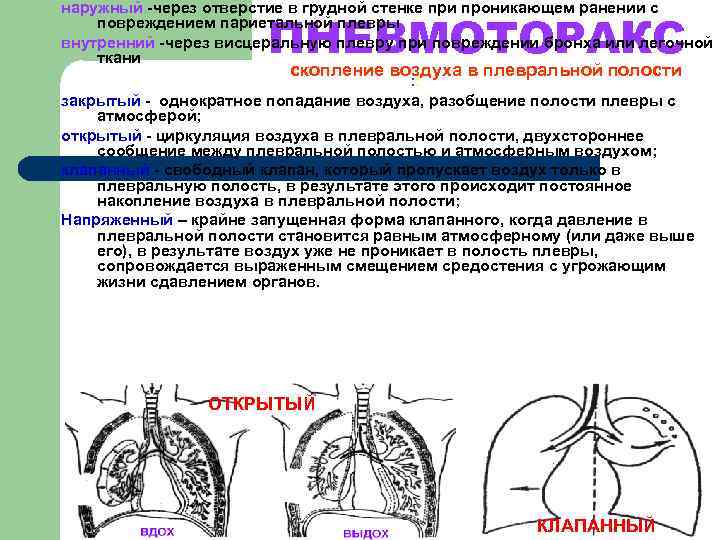 наружный -через отверстие в грудной стенке при проникающем ранении с    